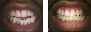 ortodoncia en colombia